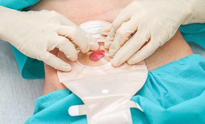 Ostomy Care Audio Course